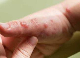 Salud Pública alerta sobre sospecha de “viruela del mono” en el país