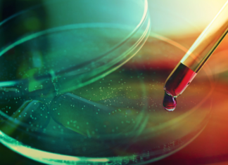 Confirman la primera coinfección por VIH, viruela del mono y COVID