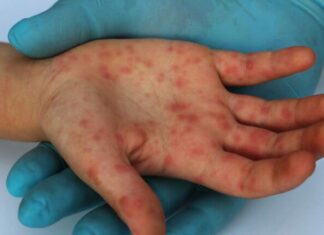 Confirman tres casos nuevos de viruela del mono en el país