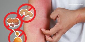 Todo lo que debes saber sobre alergias alimentarias, a favor de tu salud y la de tu familia