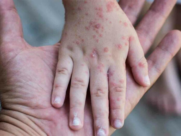 La alerta epidemiológica a nivel global, motivó a las autoridades establecer medidas de prevención tanto en las zonas fronterizas, así como, con los cluster turísticos.
