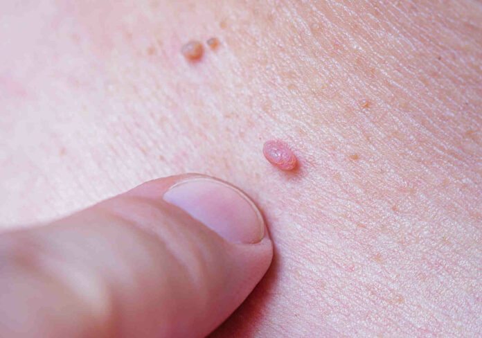 Vacuna contra el virus del papiloma humano y cáncer en urología La vacuna gardasil-9 contra el VPH o virus del papiloma humano protege contra la infección por las cepas 6, 11, 16, 18, 31, 33, 45,52 y 58, las cuales pueden causar cáncer de pene en el hombre, cáncer de cuello uterino, vagina en la mujer, y en el hombre y en la mujer cáncer oro-faríngeo y cáncer de ano.