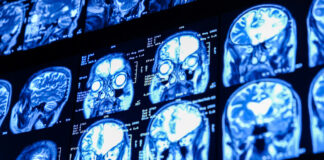 Revelan que un caso grave de covid-19 envejece el cerebro 20 años