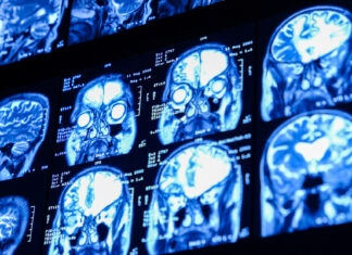 Revelan que un caso grave de covid-19 envejece el cerebro 20 años