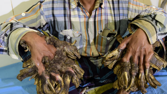 El extraño síndrome del hombre árbol: qué es y cómo afecta a quienes lo padecen