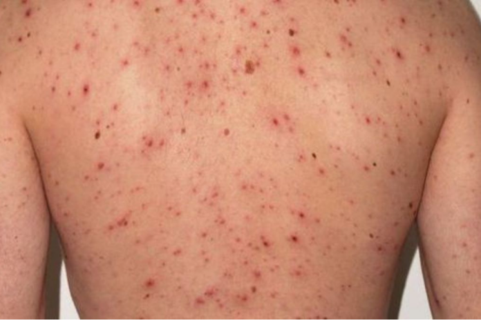 SP fortalece vigilancia epidemiológica y garantiza preparación frente al sarampión