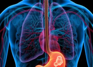 ¿Cuáles son los primeros síntomas del cáncer de estómago?