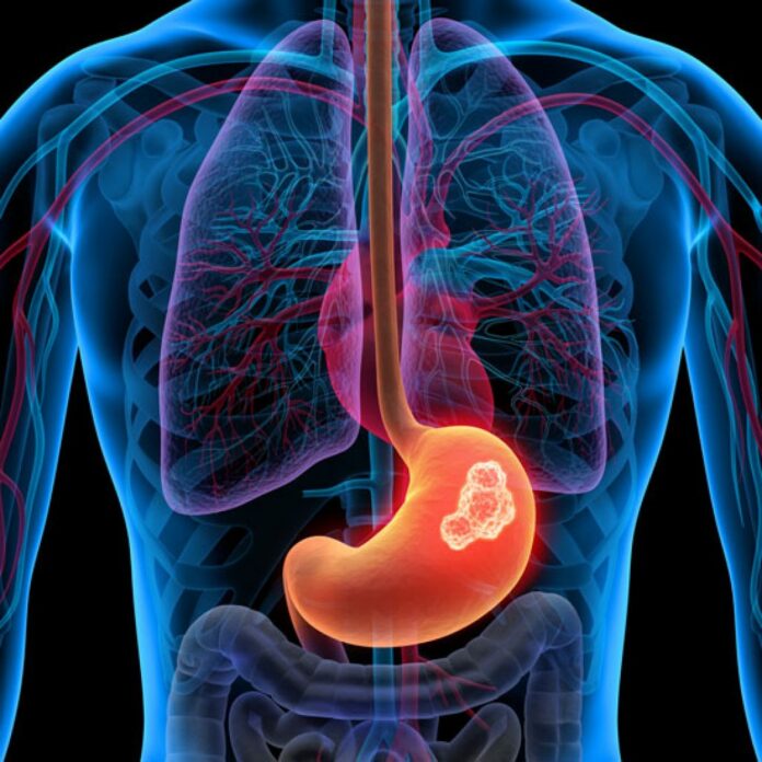 ¿Cuáles son los primeros síntomas del cáncer de estómago?
