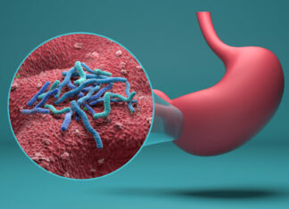 Identifican el principal factor del aumento de la incidencia del cáncer de estómago