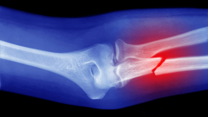 Células capaces de convertirse en hueso podrían ser la clave para curar fracturas graves