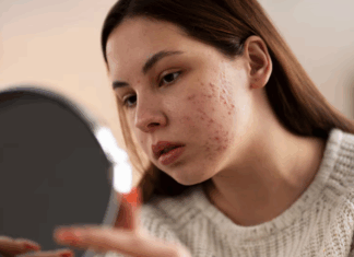 ¿Las microdosis de un medicamento pueden aliviar el acné?