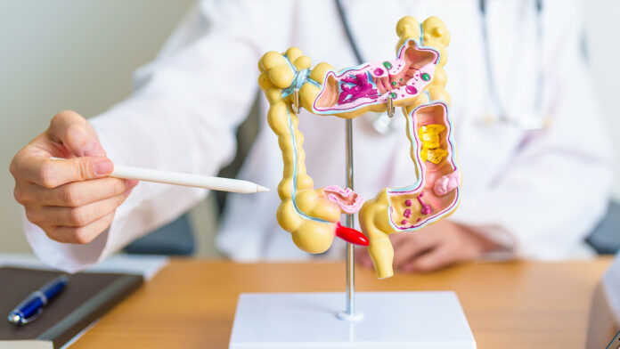 Estos simples hábitos ayudan a prevenir el cáncer de colon