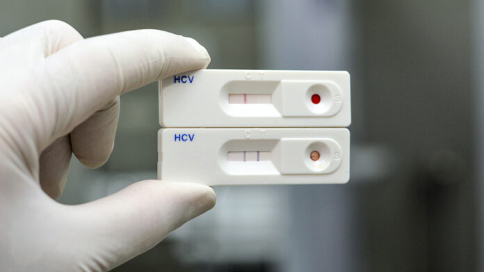 Rusia crea la primera prueba rápida del mundo para diagnosticar hepatitis C