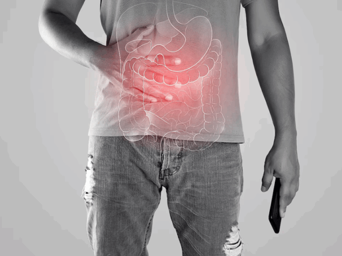 Cuáles son las nuevas recomendaciones para el tratamiento de la enfermedad de Crohn