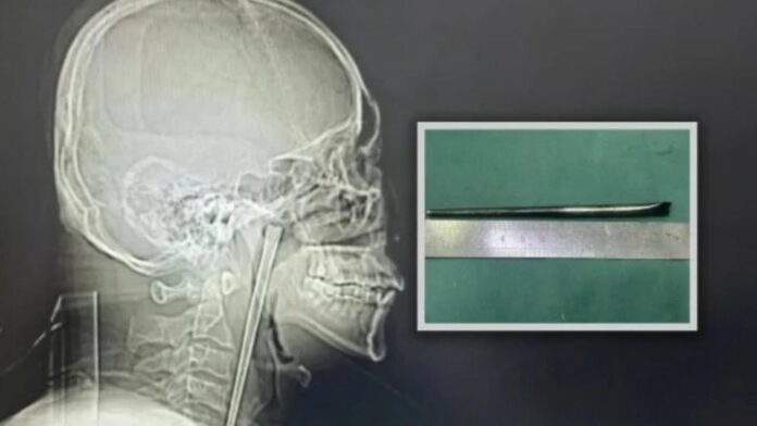Hombre vive 8 años con un palillo de metal atascado en la garganta por miedo a operarse