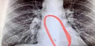 Se traga un AirPod por error y el auricular suena desde su estómago