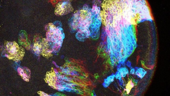 El misterio del cáncer cerebral podría tener una explicación inesperada en el cerebro