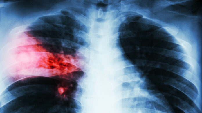 La clave contra el cáncer de pulmón podría estar en un inesperado 'interruptor metabólico'