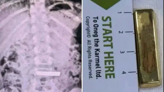 Hospitalizan a una niña de 5 años tras tragarse un lingote de oro